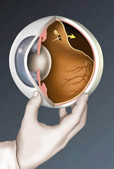 medical illustration by Phoebe Gloeckner